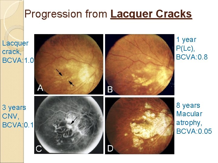 Progression from Lacquer Cracks Lacquer crack, BCVA: 1. 0 1 year P(Lc), BCVA: 0.