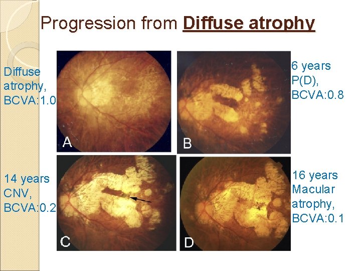 Progression from Diffuse atrophy, BCVA: 1. 0 6 years P(D), BCVA: 0. 8 14
