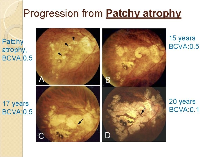 Progression from Patchy atrophy, BCVA: 0. 5 15 years BCVA: 0. 5 17 years