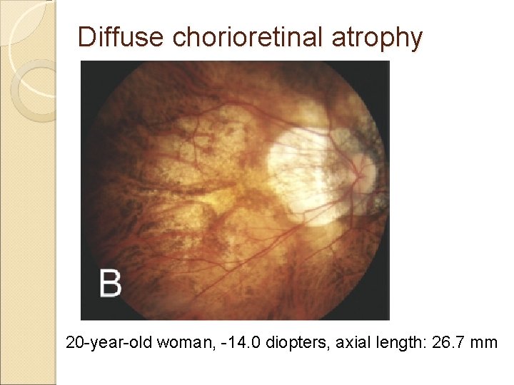 Diffuse chorioretinal atrophy 20 -year-old woman, -14. 0 diopters, axial length: 26. 7 mm