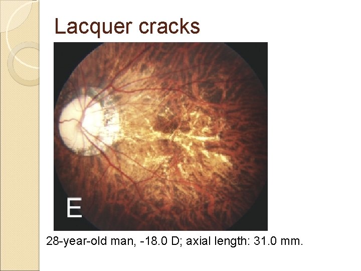 Lacquer cracks 28 -year-old man, -18. 0 D; axial length: 31. 0 mm. 