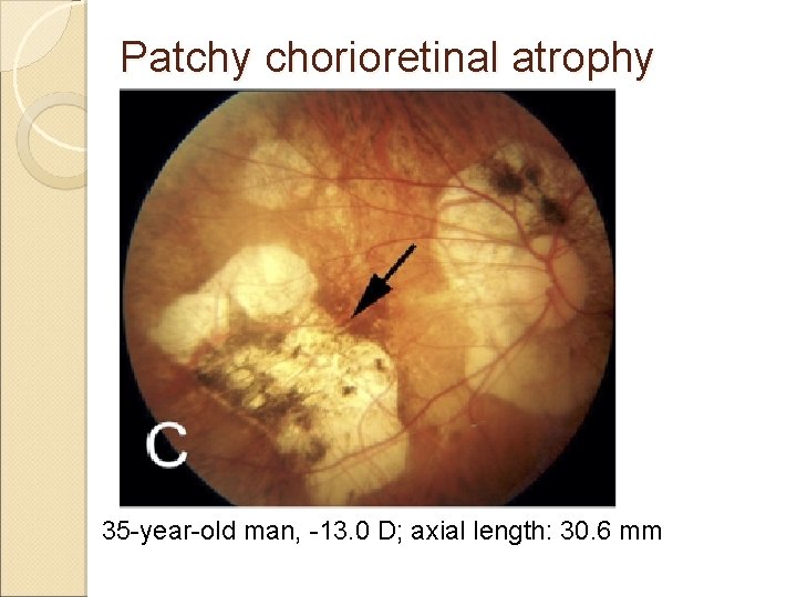 Patchy chorioretinal atrophy 35 -year-old man, -13. 0 D; axial length: 30. 6 mm