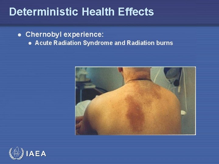 Deterministic Health Effects l Chernobyl experience: l Acute Radiation Syndrome and Radiation burns 