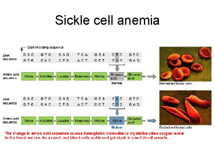Sickle cell anemia 