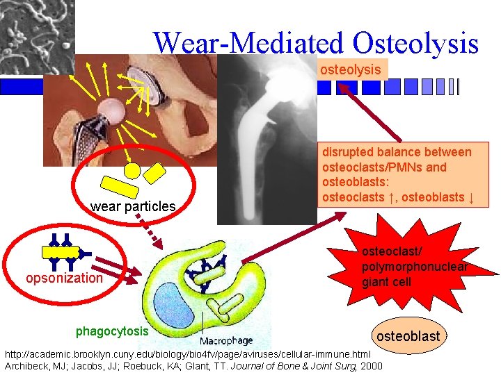 Wear-Mediated Osteolysis osteolysis wear particles opsonization phagocytosis disrupted balance between osteoclasts/PMNs and osteoblasts: osteoclasts