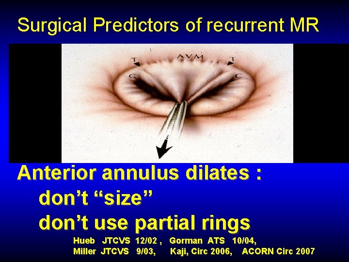 Surgical Predictors of recurrent MR Anterior annulus dilates : don’t “size” don’t use partial