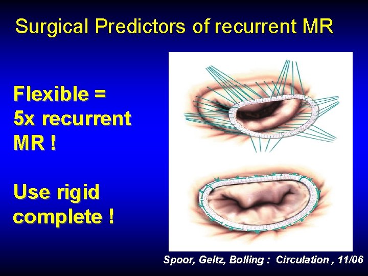 Surgical Predictors of recurrent MR Flexible = 5 x recurrent MR ! Use rigid