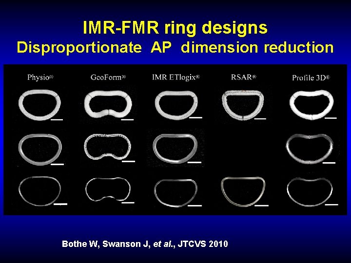 IMR-FMR ring designs Disproportionate AP dimension reduction Bothe W, Swanson J, et al. ,