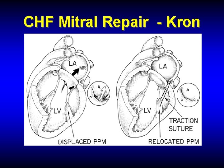 CHF Mitral Repair - Kron 