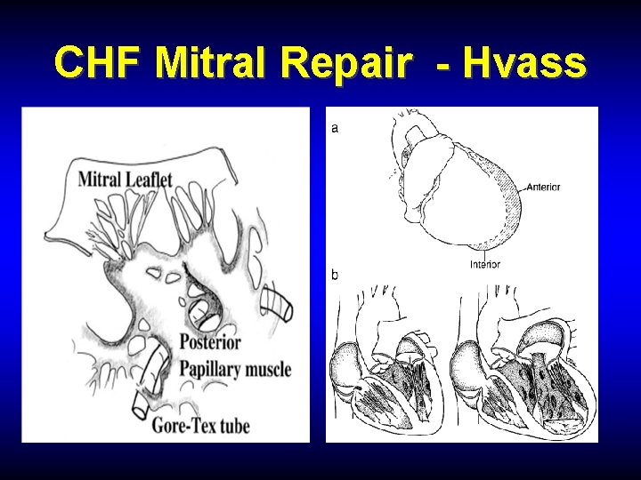 CHF Mitral Repair - Hvass 