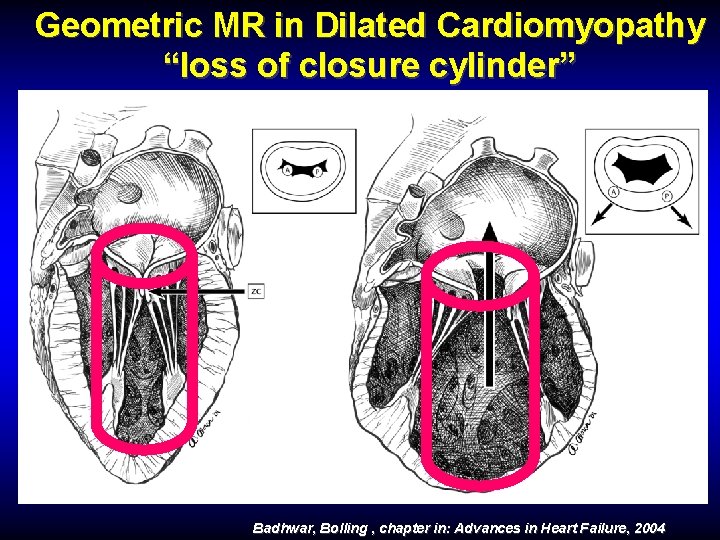 Geometric MR in Dilated Cardiomyopathy “loss of closure cylinder” Badhwar, Bolling , chapter in: