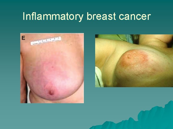 Inflammatory breast cancer 