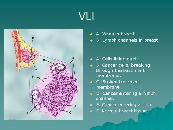 VLI u u u u A. Veins in breast B. Lymph channels in breast