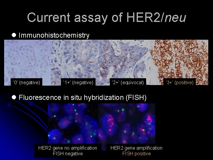 Current assay of HER 2/neu l Immunohistochemistry ‘ 0’ (negative) ‘ 1+’ (negative) ‘