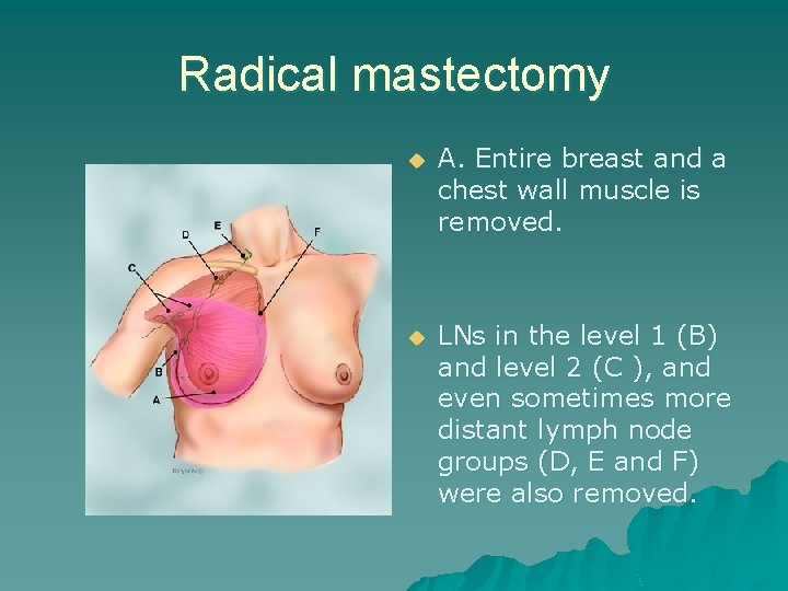 Radical mastectomy u A. Entire breast and a chest wall muscle is removed. u