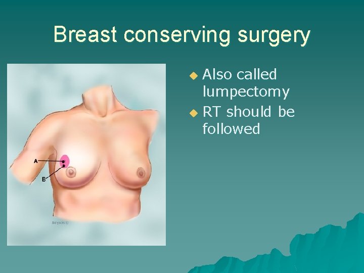 Breast conserving surgery Also called lumpectomy u RT should be followed u 