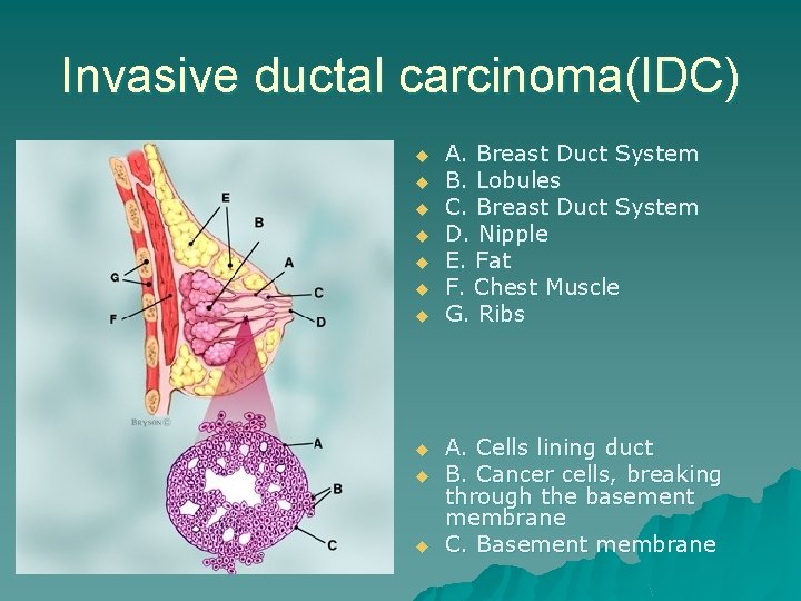 Invasive ductal carcinoma(IDC) u u u u u A. Breast Duct System B. Lobules