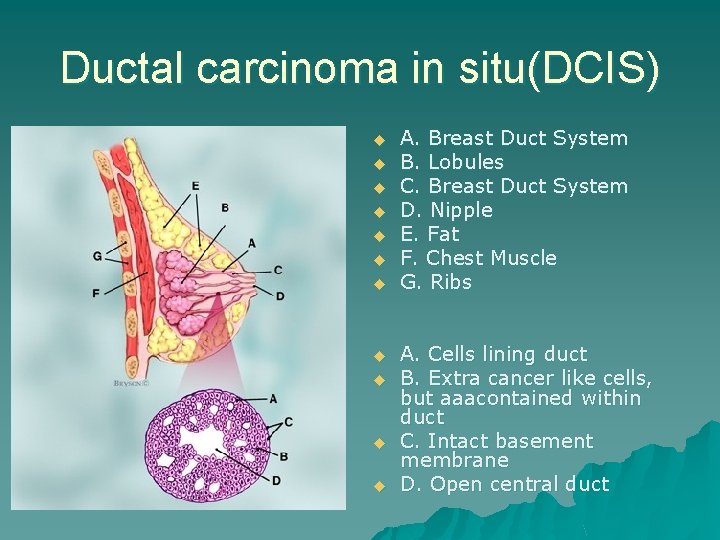 Ductal carcinoma in situ(DCIS) u u u A. Breast Duct System B. Lobules C.