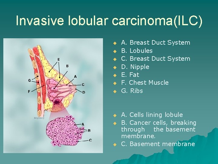 Invasive lobular carcinoma(ILC) u u u u u A. Breast Duct System B. Lobules