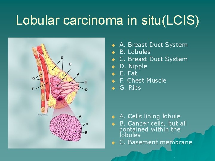Lobular carcinoma in situ(LCIS) u u u u u A. Breast Duct System B.
