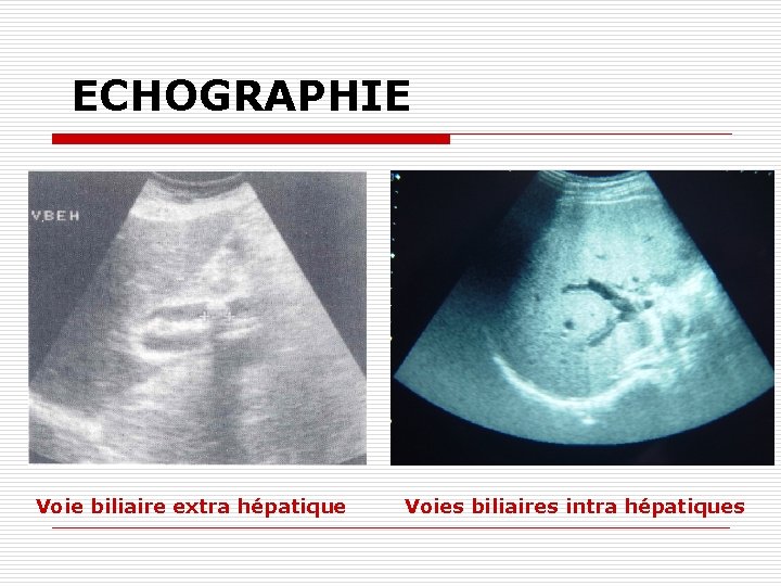 ECHOGRAPHIE Voie biliaire extra hépatique Voies biliaires intra hépatiques 