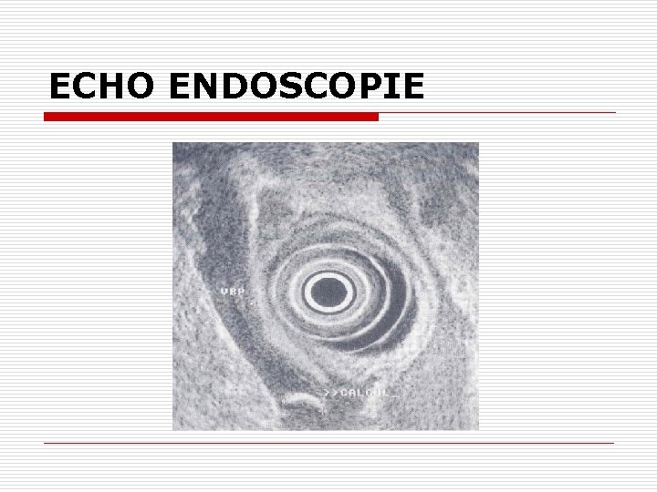 ECHO ENDOSCOPIE 