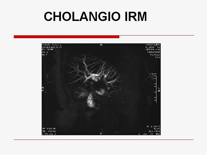 CHOLANGIO IRM 