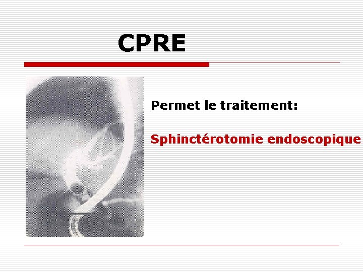 CPRE Permet le traitement: Sphinctérotomie endoscopique 