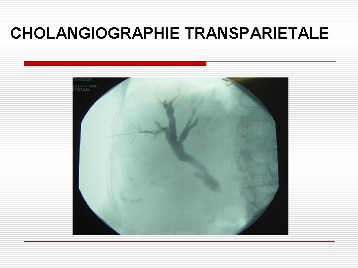 CHOLANGIOGRAPHIE TRANSPARIETALE 
