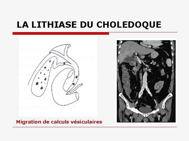 LA LITHIASE DU CHOLEDOQUE Migration de calculs vésiculaires 