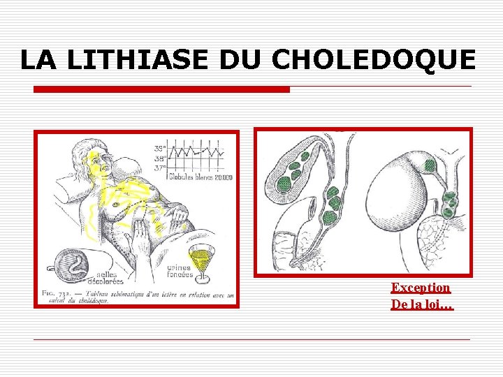 LA LITHIASE DU CHOLEDOQUE Exception De la loi… 