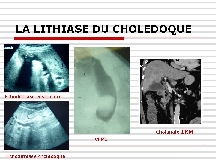 LA LITHIASE DU CHOLEDOQUE Echo: lithiase vésiculaire Cholangio CPRE Echo: lithiase cholédoque IRM 