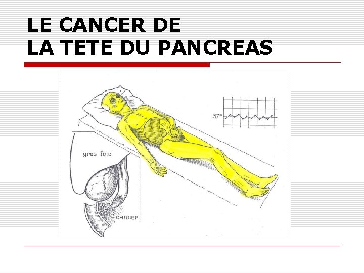LE CANCER DE LA TETE DU PANCREAS 