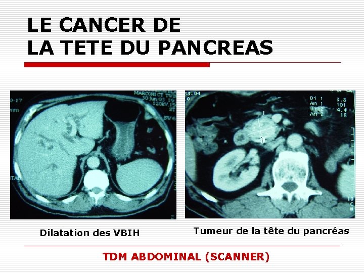 LE CANCER DE LA TETE DU PANCREAS Dilatation des VBIH Tumeur de la tête