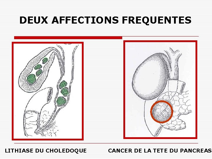 DEUX AFFECTIONS FREQUENTES LITHIASE DU CHOLEDOQUE CANCER DE LA TETE DU PANCREAS 