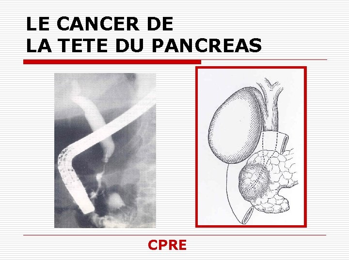 LE CANCER DE LA TETE DU PANCREAS CPRE 