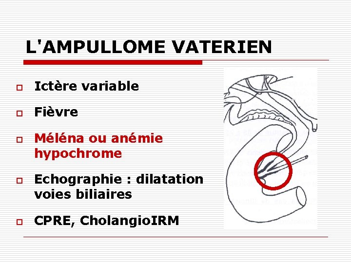 L'AMPULLOME VATERIEN o Ictère variable o Fièvre o o o Méléna ou anémie hypochrome