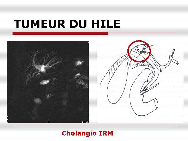 TUMEUR DU HILE Cholangio IRM 