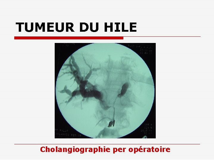 TUMEUR DU HILE Cholangiographie per opératoire 