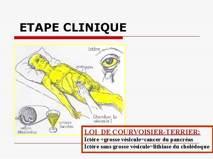 ETAPE CLINIQUE LOI DE COURVOISIER-TERRIER: Ictère +grosse vésicule=cancer du pancréas Ictère sans grosse vésicule=lithiase