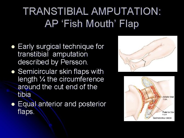 TRANSTIBIAL AMPUTATION: AP ‘Fish Mouth’ Flap l l l Early surgical technique for transtibial