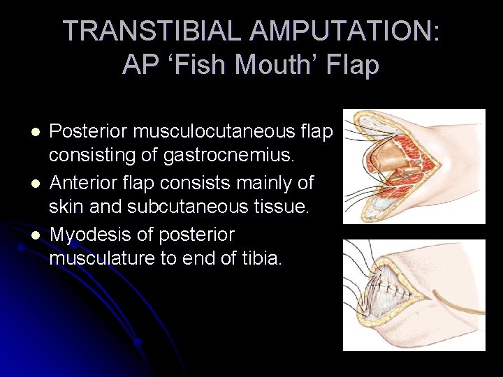 TRANSTIBIAL AMPUTATION: AP ‘Fish Mouth’ Flap l l l Posterior musculocutaneous flap consisting of