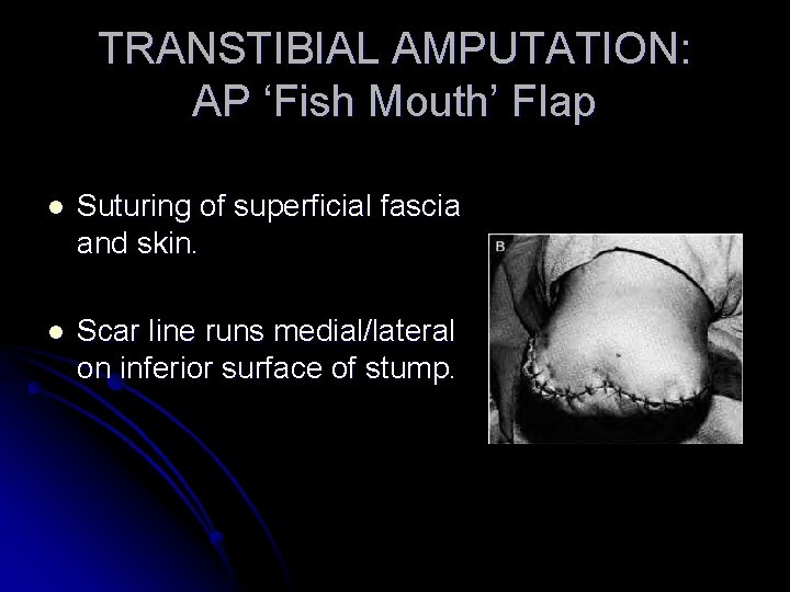 TRANSTIBIAL AMPUTATION: AP ‘Fish Mouth’ Flap l Suturing of superficial fascia and skin. l