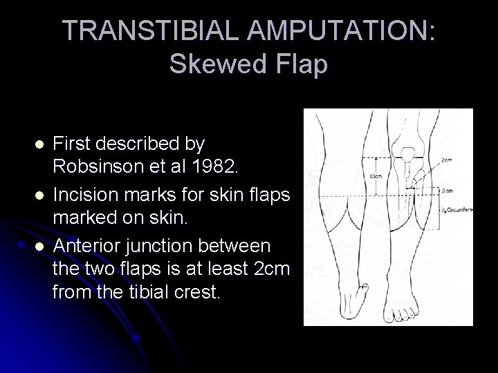 TRANSTIBIAL AMPUTATION: Skewed Flap l l l First described by Robsinson et al 1982.