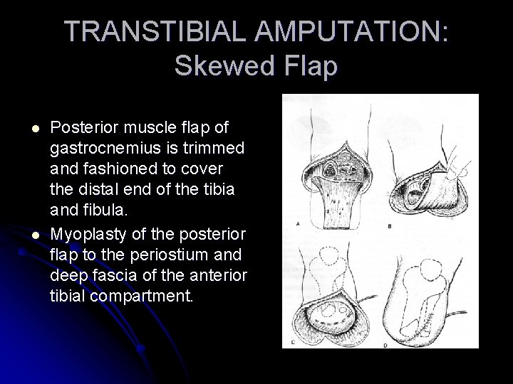 TRANSTIBIAL AMPUTATION: Skewed Flap l l Posterior muscle flap of gastrocnemius is trimmed and