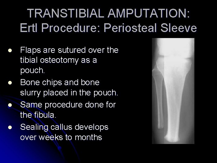 TRANSTIBIAL AMPUTATION: Ertl Procedure: Periosteal Sleeve l l Flaps are sutured over the tibial