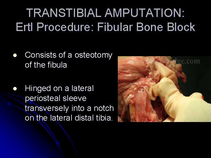 TRANSTIBIAL AMPUTATION: Ertl Procedure: Fibular Bone Block l Consists of a osteotomy of the