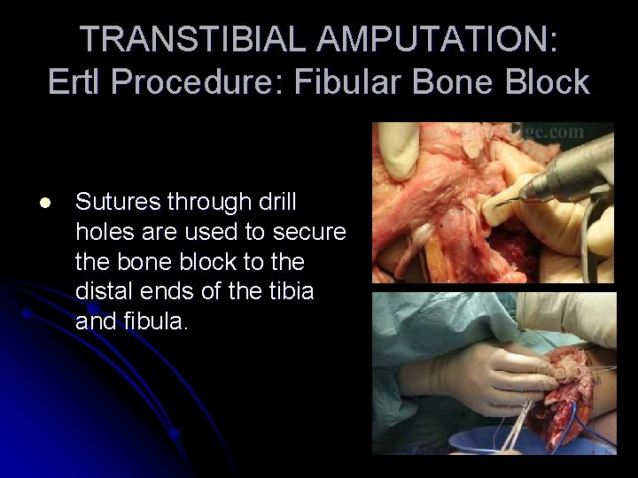 TRANSTIBIAL AMPUTATION: Ertl Procedure: Fibular Bone Block l Sutures through drill holes are used