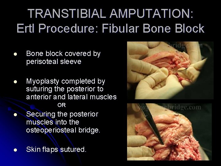 TRANSTIBIAL AMPUTATION: Ertl Procedure: Fibular Bone Block l Bone block covered by perisoteal sleeve