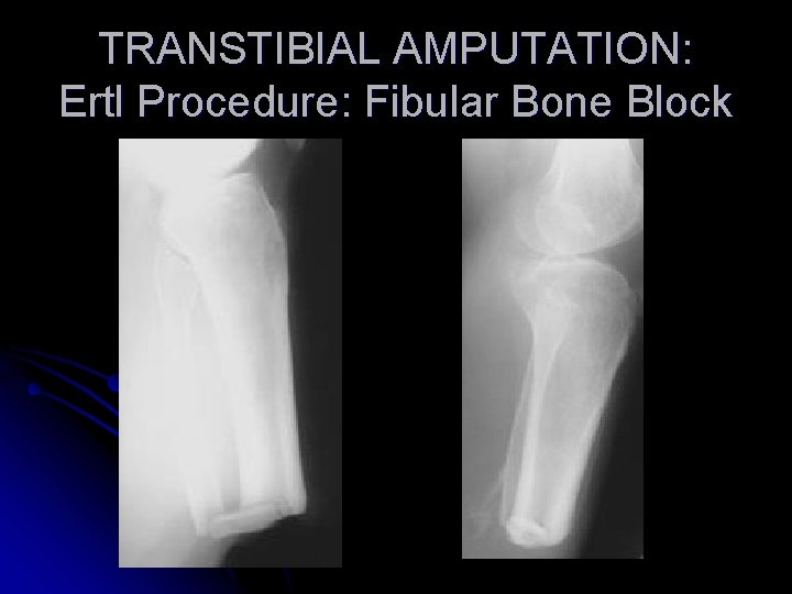 TRANSTIBIAL AMPUTATION: Ertl Procedure: Fibular Bone Block 